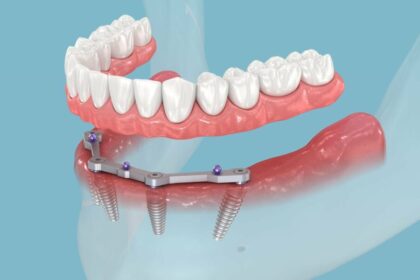 transforming-smiles-with-all-on-4-dental-implants